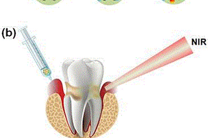 介孔硅負載氮摻雜石墨烯納米復合材料在制備光熱治療牙周炎藥物上的應用及制備方法