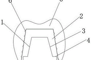 3D打印鈦基復(fù)合材料義齒