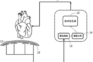 心臟起搏器